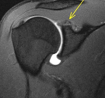 Figure 6 for case Posterior Peel Back Lesion of Internal Impingement